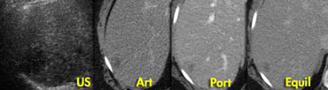 Adenoma: non-specific features on CT