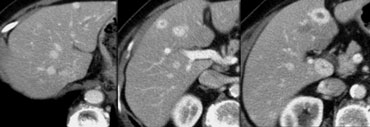 Hypervascular metastases with typical peripheral enhancement