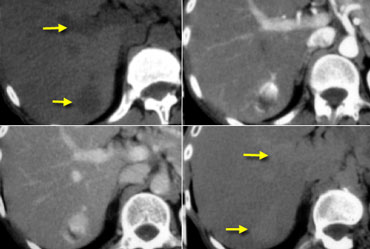 Hemangioma on NECT, late arterial, late portal venous and equilibrium phase. Notice that the attenuation of the hemangioma matches the bloodpool in every single phase (arrows).