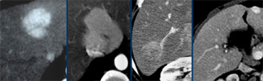 Four different tumors with enhancement in the late arterial phase. From left to right: HCC in cirrhotic liver; FNH with central scar in adolescent; adenoma in young woman on contraceptives and finally a hemangioma with typical enhancement in the other phases (not shown).