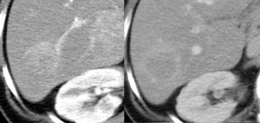 Capsule in Adenoma not seen in portal venous phase and well appreciated in delayed phase