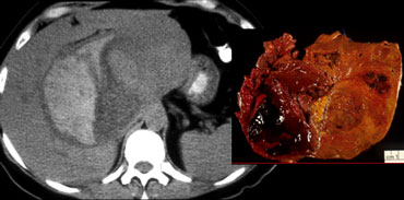 Hemorrhage within an adenoma.