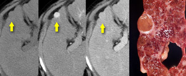 Small HCC seen only in arterial phase in a patient with cirrhosis.