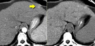 Arterial phase (left) and NECT (right)