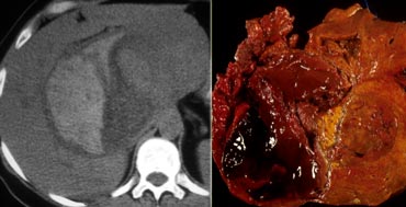 Adenoma with hemorrhage.