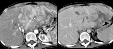 LEFT: FLC in late arterial phase: central calcification and heterogenous enhancement in a lamellar pattern. RIGHT: venous phase with hypodense central scar.