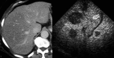 Steatosis of right liver lobe. No lesions detectable. On US multiple lesions in the same region.