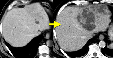 LEFT: Small cyst-like lesion after recent ERCPRIGHT: 3 weeks later a large absces had developed.