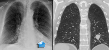 T1 tumor – A typical T1 tumor in the left lower lobe, completely surrounded by pulmonary parenchyma.