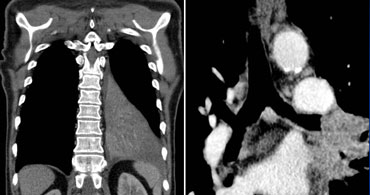 T2 tumor - A typical T2 tumor with atelectasis/pneumonitis of the left lower lobe up to the hilum, due to involvement of the left main bronchus.