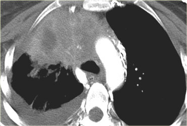 T4 tumor – A typical T4 tumor in the right upper lobe with invasion of the mediastinum.