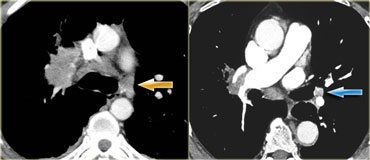 Two patients with N3-disease.