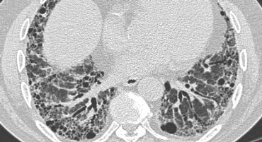 Typical UIP with honeycombing and traction bronchiectasis in a patient with idiopathic pulmonary fibrosis (IPF)