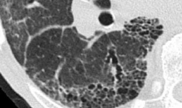 Honeycombing in a patient with UIP