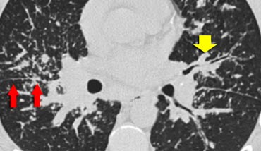 Sarcoidosis