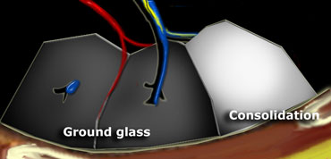 Dark bronchus sign in ground glass opacity. Complete obscuration of vessels in consolidation.