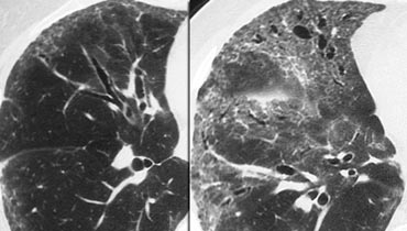 Non specific interstitial pneumonitis (NSIP). Notice lower lobe predominance.