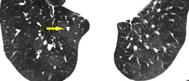 Mosaic pattern in a patient with chronic thromboemboli