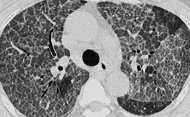 Crazy Pavin in a patient with Alveolar  proteinosis.