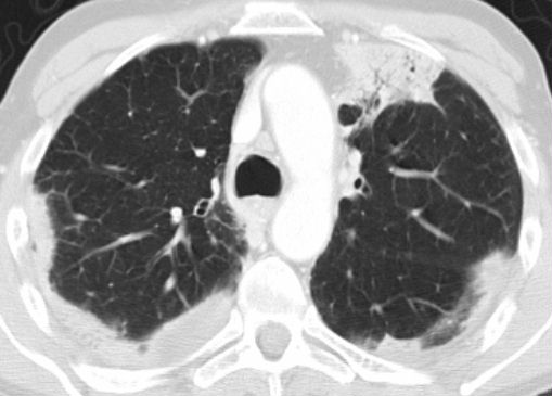 Chronic eosinophilic granuloma