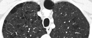 Paraseptal emphysema with small bullae