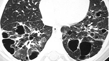 Langerhans cell histiocytosis