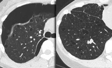 Lymphangiomyomatosis complicated by pneumothorax