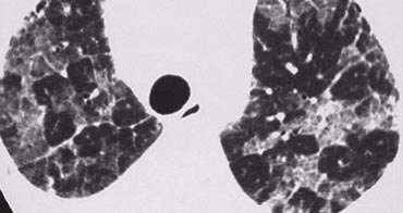 Alveolar proteinosis with crazy paving pattern