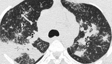 Sarcoidosis with conglomerate masses of fibrous tissue