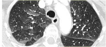 Cardiogenic pulmonary edema