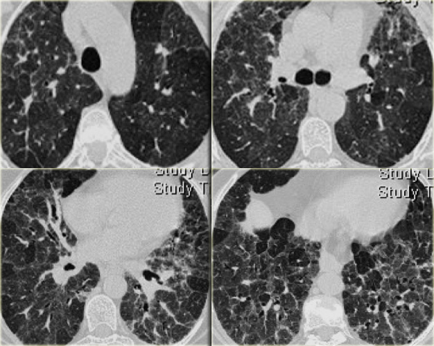 Chronic hypersensitivity pneumonitis.