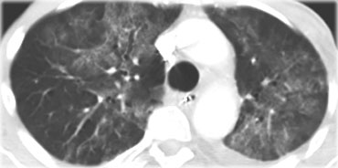 PCP with diffuse ground-glass opacification