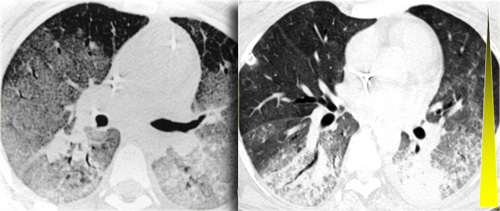 Extra-pulmonary ARDS with gravity dependent gradient