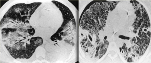 Pulmonary ARDS with asymmetric patchy distribution of consolidations.