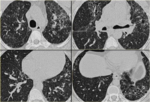 Drug-induced interstitial lung fibrosis