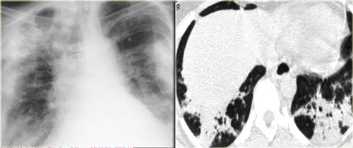 Drug-induced organizing pneumonia