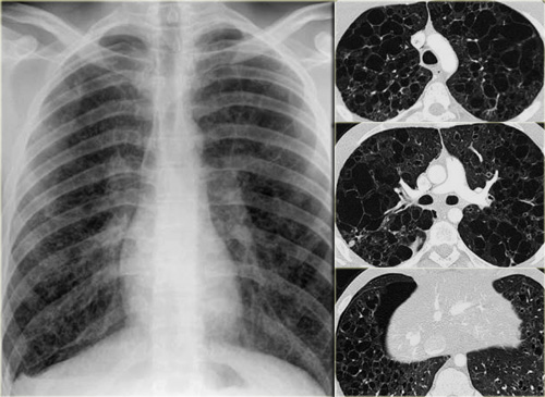 Langerhans' cell histiocytosis