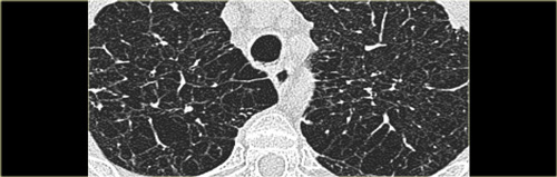 Emphysema mimicking Langerhans cell histiocytosis