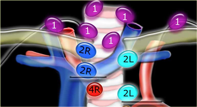 1. Supraclavicular zone nodes