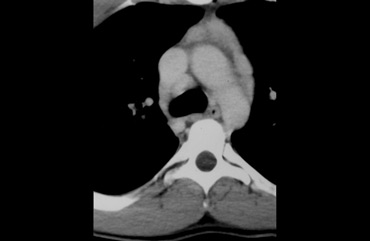 Multiple enhancing lesions in multiple compartments