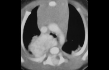 Enhancing posterior mediastinal mass in a child.