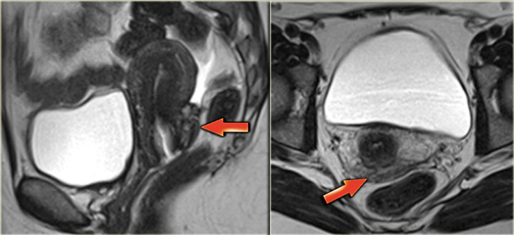 Retrocervical endometriosis