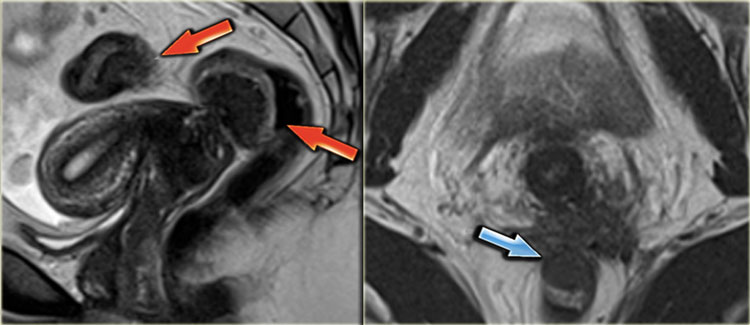 Rectal endometriosis