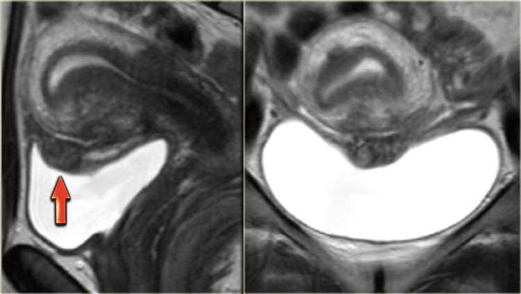 Bladder wall endometriosis