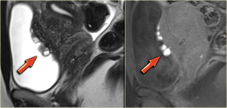 Bladder wall endometriosis