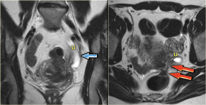 Endometriosis complicated by hydronephrosis