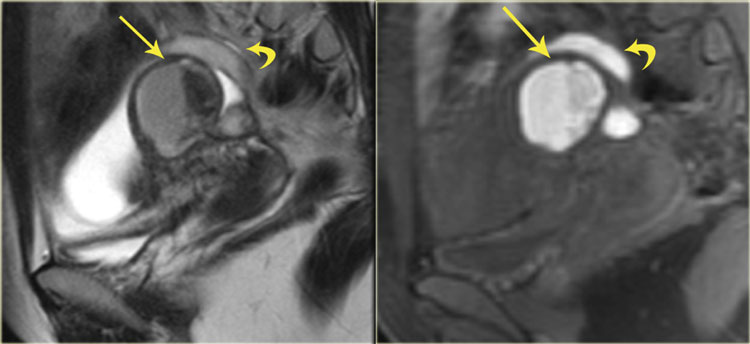 Endometrioma