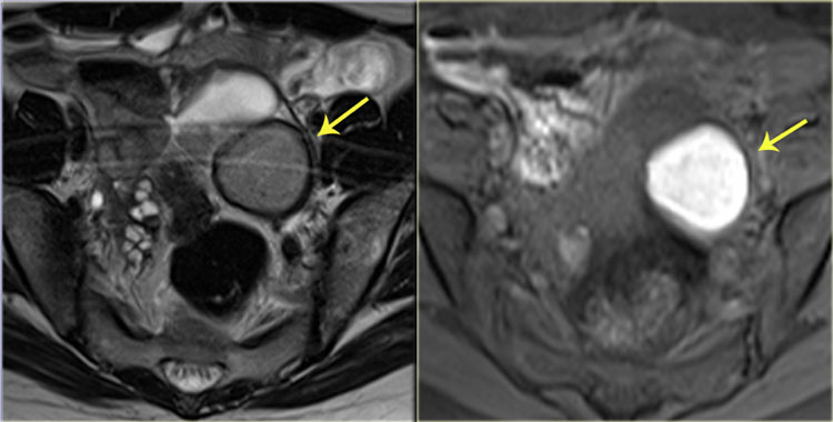 Endometrioma