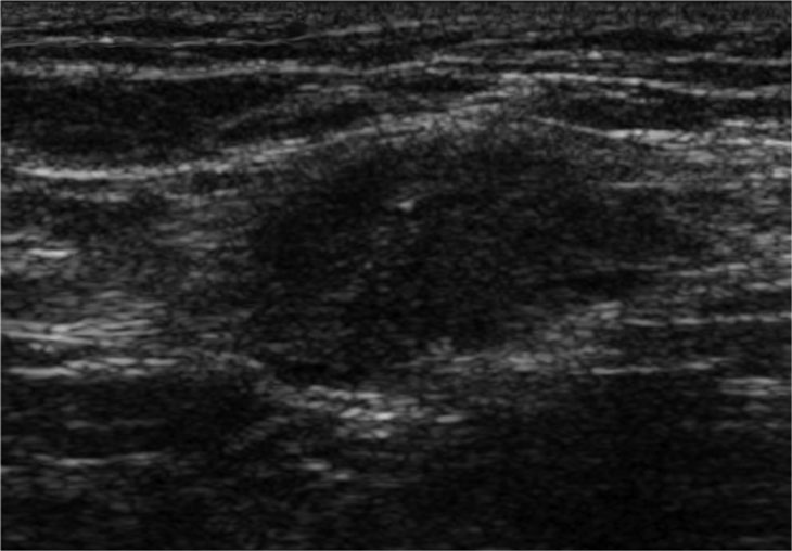 Abdominal wall endometriosis presenting as ill-defined hypo echoic mass.