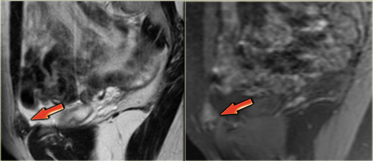 Abdominal wall endometriosis